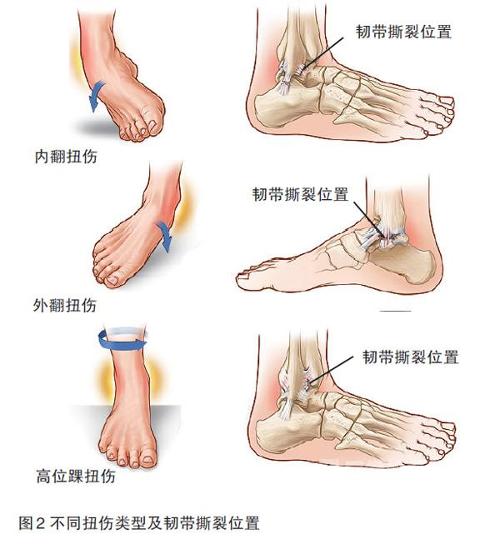 踝关节扭伤推拿治疗技术