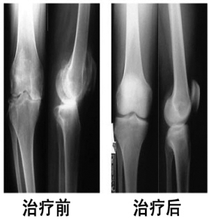 半月板损伤推拿治疗技术